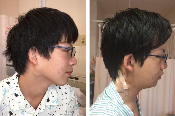 上村さん手術前と手術後の写真